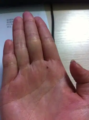 手心上长了个黑痣,怎么回事