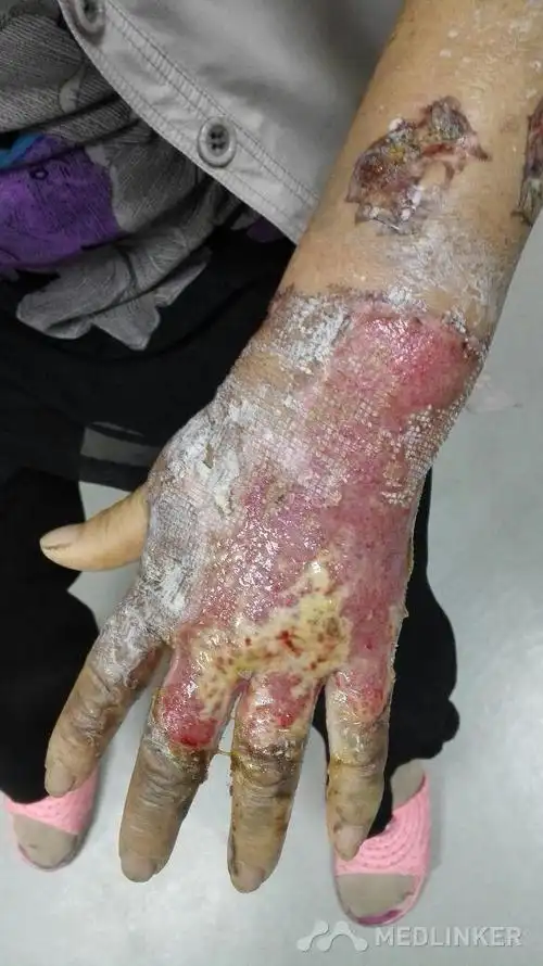 热水烫伤8烧伤溶痂中