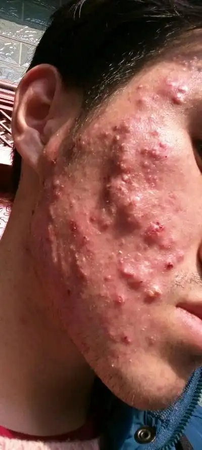 反反复复7年的毛囊炎终于好了,真的不容易