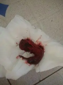 40天药流排出孕囊图片 - 搜狗图片搜索