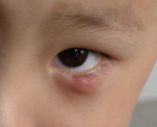 眼角长了个疙瘩图片 (16)_有来医生