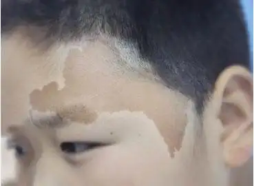 各种面部色斑的治疗