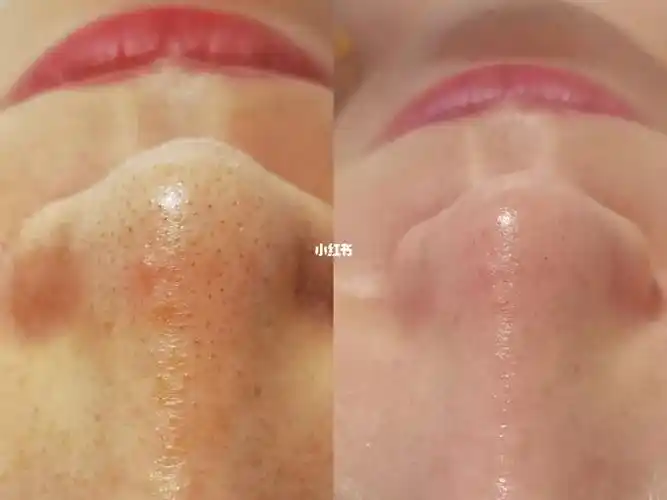 毛孔深层清洁对比图