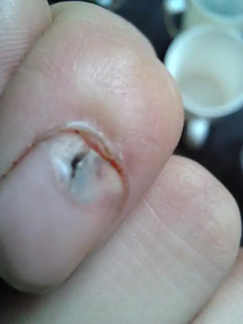 我的手指甲被东西砸到了根部,请问还会长吗?长出后会和肉分开吗?