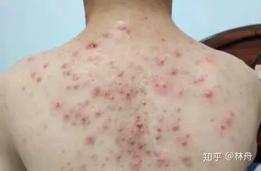 请问这真的是毛囊炎嚒?怎么处理呢?