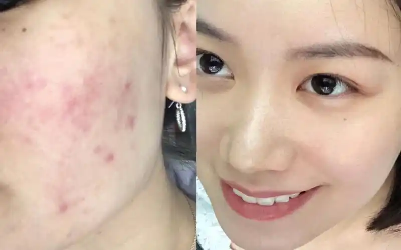 【旦旦ya】油性皮肤/遗传性痘痘肌/如何正确挤痘痘不留痘印/祛痘产品