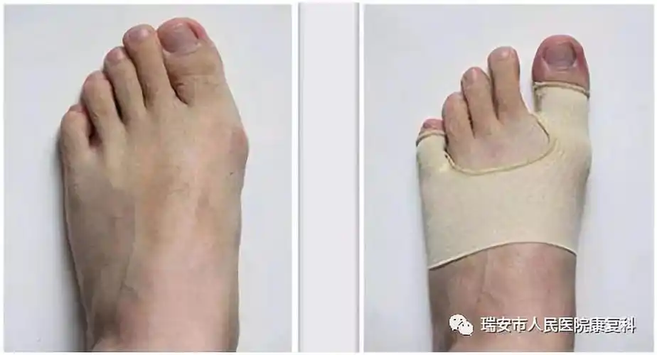 当以上保守治疗不能有效地矫正时,应采取手术治疗.