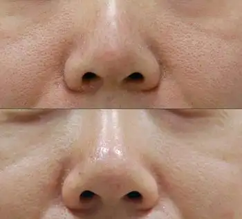 缩小毛孔什么方法好呢