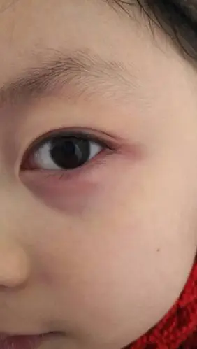 孩子下眼睑像起了个包,下眼皮红