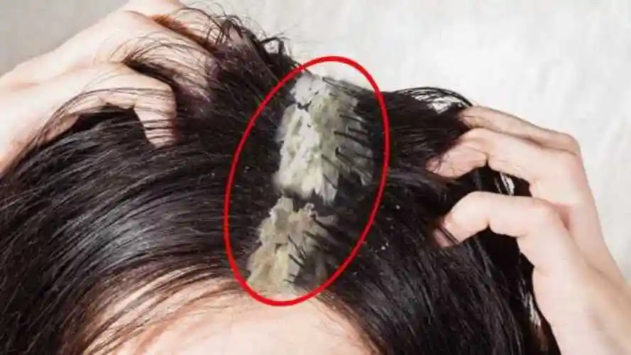 头皮屑到底有多可怕镜头放大1000倍全程触目惊心