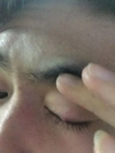 眼皮出个疙瘩,看看怎么回事以前做过霰粒肿手术