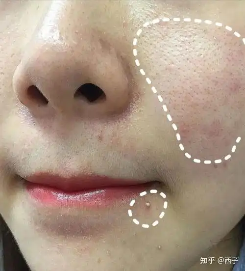 油性皮肤加敏感肌,怎么养成一张干净白皙的脸? - 知乎