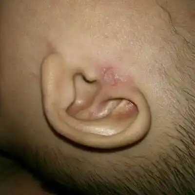 宝宝五个多月,两边耳朵都会有这种红色的东西,我给