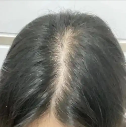 女生 发量少 头顶快秃了 有没有什么好的生发方法!跪求!