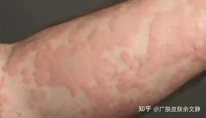 今天跟大家简单说一下如何辨别湿疹和荨麻疹