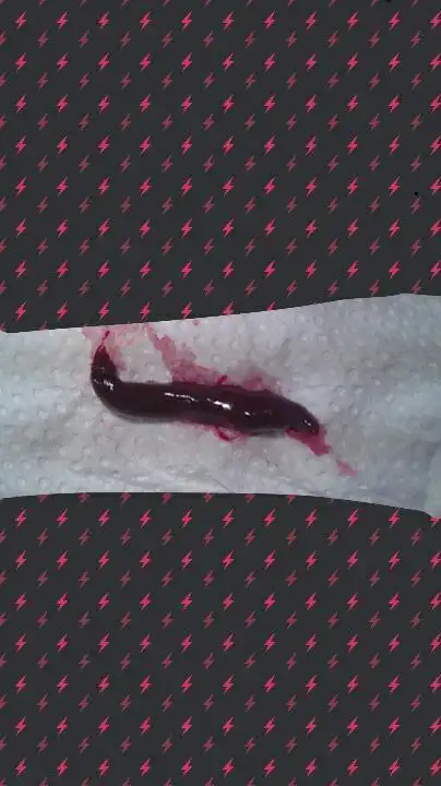 药物流产第一天晚上这个出来了,然后就出血量少了,可第三天的时候突然