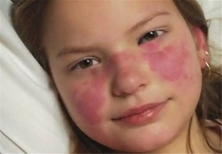 红斑狼疮早期手腕症状图片