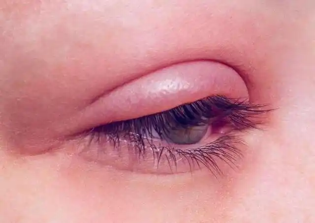 肾病出现脸部往往会有特征,有部分人脸部浮肿,特别是眼睑部位,和肾脏