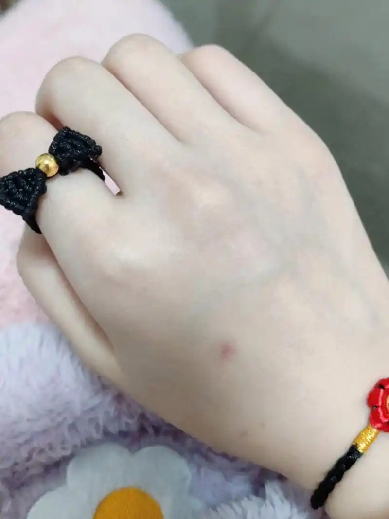 这是什么痣? 有人知道这是什么吗?