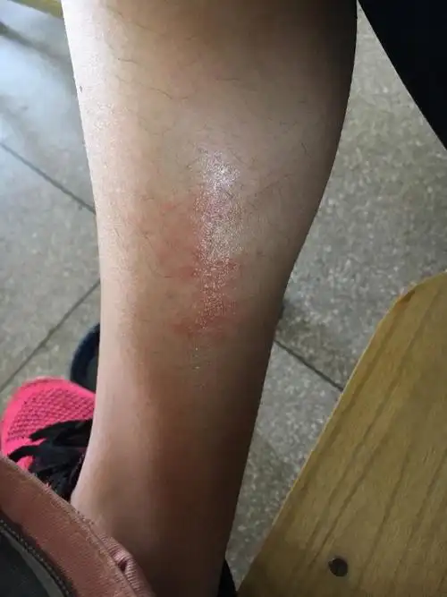小腿上长了这个一片 很痒 擦了皮炎平 吃了氯雷他定.但是还是很痒 怎