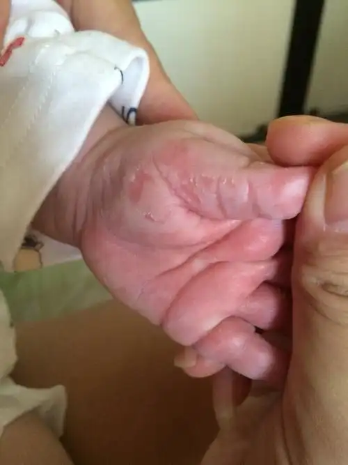 3个半月宝宝吃手后掉皮,是正常的还是有问题?