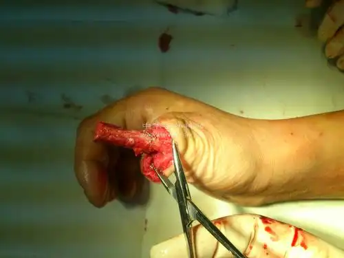 [手指再造] 拇指三度缺损后再造术