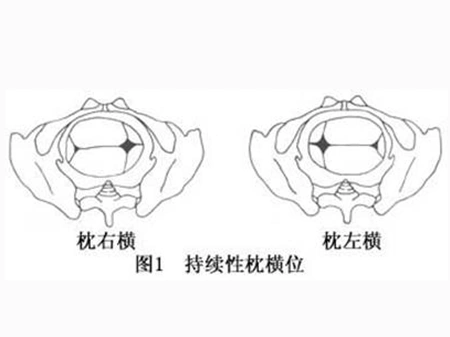 胎方位是指胎儿先露部位和产妇骨盆前,后,左,右的关系,简称胎位.