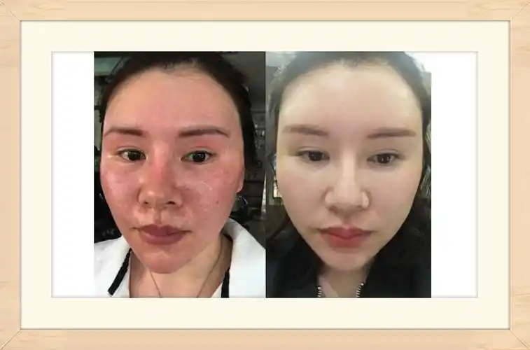 化妆品加工厂告诉你使用化妆品过敏了怎么办