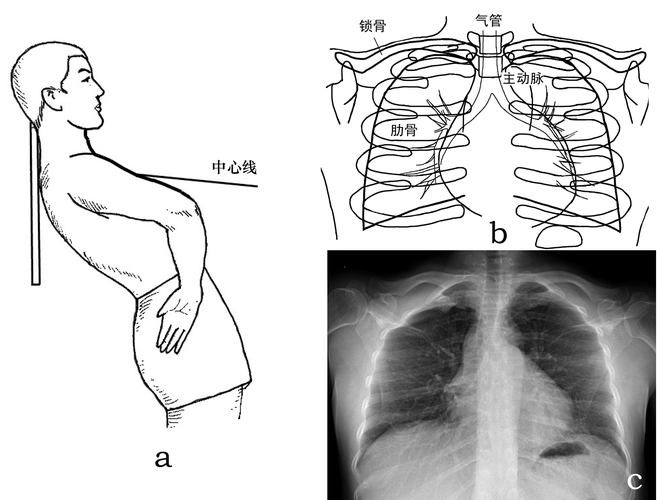 胸部x线摄影体位及临床意义