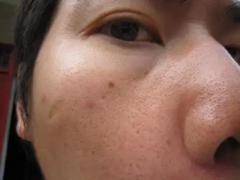 脸上毛孔拥挤出白色东西,毛孔粗大怎么办?