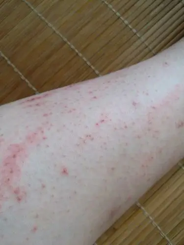 腿部好痒,抓出来这样,什么原因?