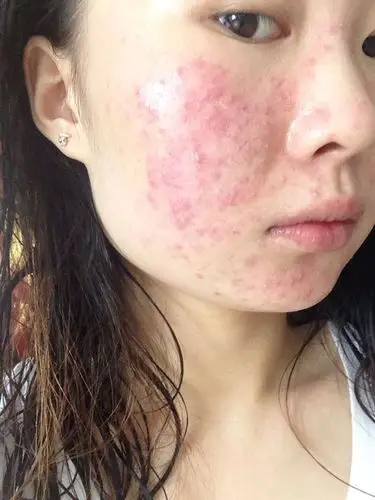 皮肤经常过敏怎么办