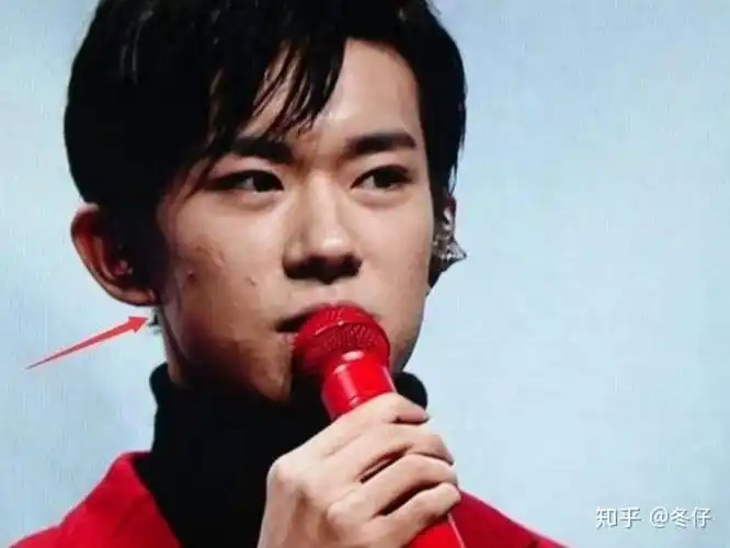 王源皮肤问题又上热搜满脸痘印还红肿上节目总是磨皮