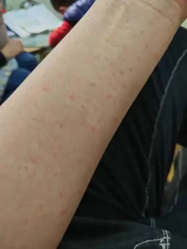 只要身上一热就痒,全身起红点,治疗了10多天,现在症状缓解了很多,图一