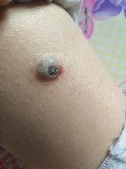 腿上长个包,就像火山口一样,里边包着个黑色的硬