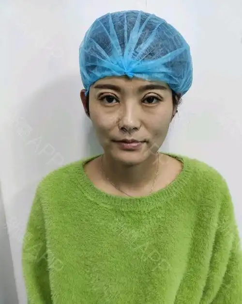 沈阳埋线双眼皮好不好_效果图_酷酷的拿姐埋线双眼皮术后第0天_新氧