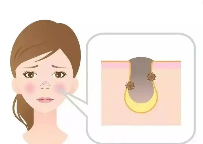 去黑头最有效的方法(还在为脸上的黑头苦恼吗)-万思特网