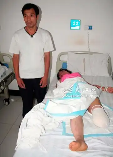 女子患严重脚疾瞒丈夫七年脚掌烂脱落被截肢图