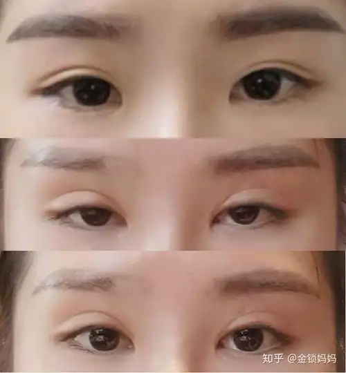 一定要谨慎,有的人并不适合双眼皮,我割完超级显老,而且都没割好,图一