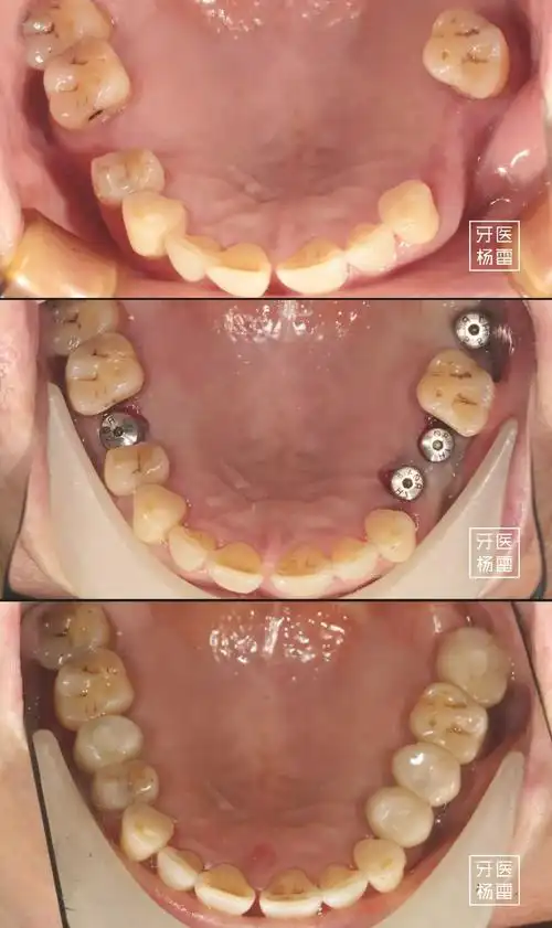 去美容院花47万做的种植牙,没多久全部破损