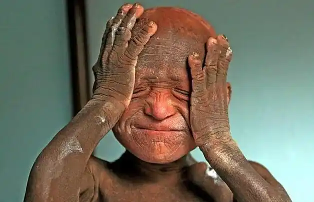 尼泊尔11岁的小男孩儿拉梅什患有"鱼鳞病",身上长满了麟屑的他,没什么