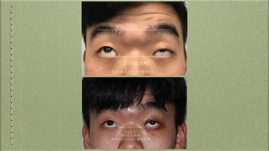 cfs～上睑下垂,用案例说话 - 好大夫在线