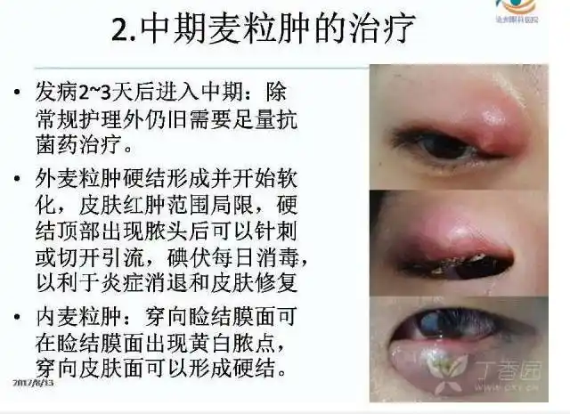 麦粒肿和霰粒肿的个体化分期治疗