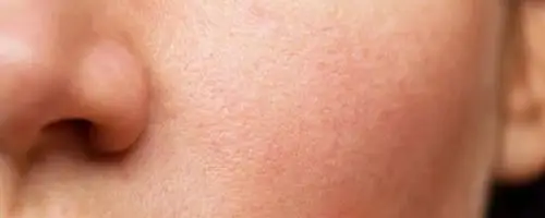 脸部粗糙干燥需要使用面膜或者水膜.