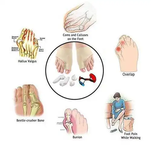 无锡拇外翻的手术有哪些