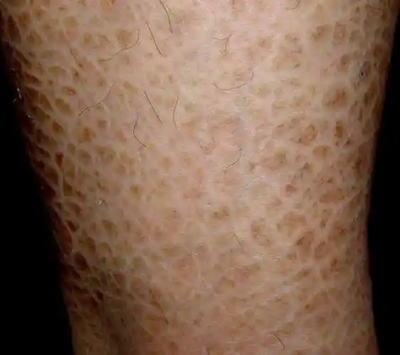 p>寻常型鱼鳞病(ichthyosis vulgaris) 此型最常见,一般冬重夏轻.