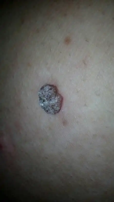 腿上长了一个痘痘,有点脏感觉,不疼不痒,也没见变大,豆子大小,有点硬