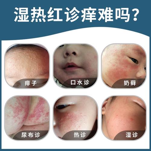 湿疹婴儿专用宝宝奶癣干性疹儿童荨麻皮肤瘙痒过敏止痒婴宝湿疹霜