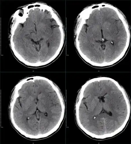 67超急性期大面积脑梗死ct平扫表现
