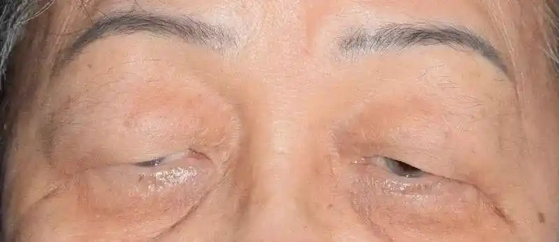 重症肌无力患者的眼睛护理